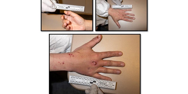 Brett Gitchel was covered in cuts, scrapes and bruises when police questioned him, according to court documents. These images show apparent bite marks on his hands after he allegedly attacked a missing woman's son, who has special needs.