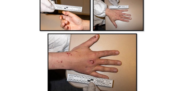 Brett Gitchel was covered in cuts, scrapes and bruises when police questioned him, according to court documents. These images show apparent bite marks on his hands after he allegedly attacked a missing woman's son, who has special needs.