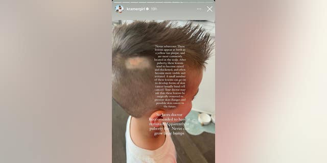 jana kramers son jaces birthmark on the side of his scalp