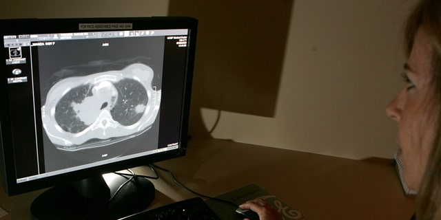 Radiology technologist Mary McPolin looks at a CT scan of a lung with a tumor at the UCSF Comprehensive Cancer Center in San Francisco on Aug. 17, 2005.