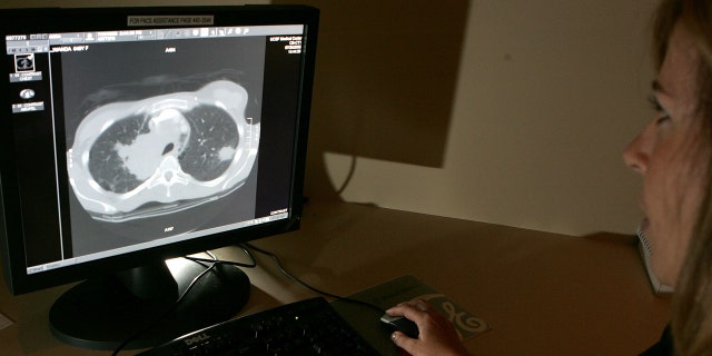 Radiology technologist Mary McPolin looks at a CT scan of a lung with a tumor at the UCSF Comprehensive Cancer Center in San Francisco on Aug. 17, 2005.