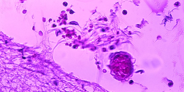 Mild meningitis with hemorrhage due to Bacillus anthracis. Photomicrograph of mild meningitis along with hemorrhage, and the presence of Bacillus anthracis in a case of fatal human anthrax.