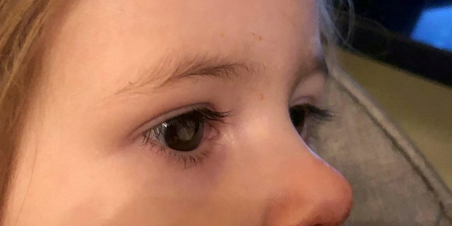 The white glow was spotted in the little girl's eye just after her second birthday.