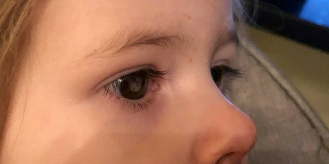 The white glow was spotted in the little girl's eye just after her second birthday.