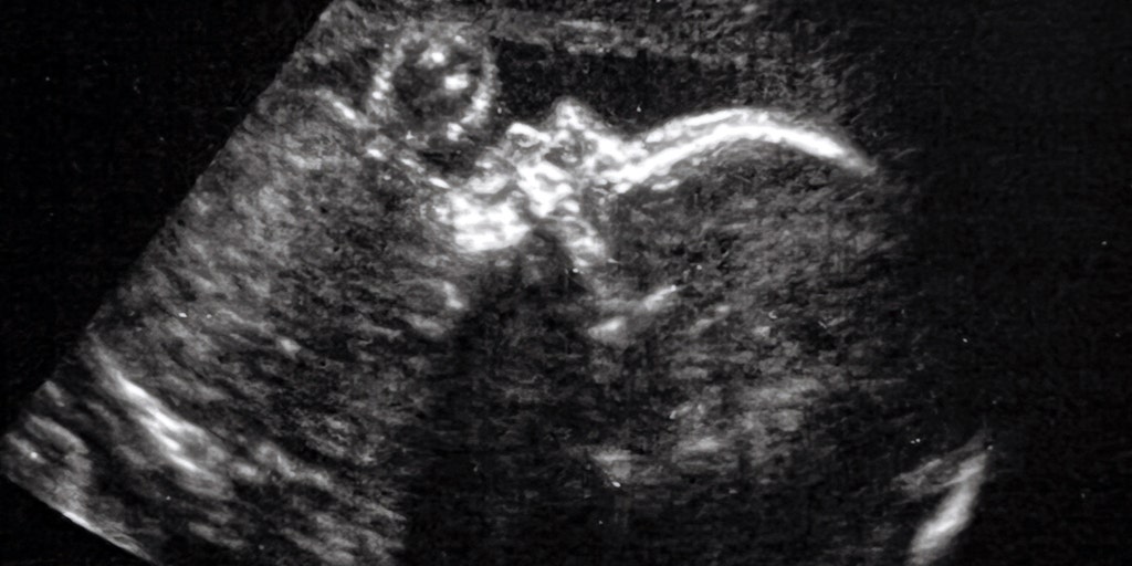 Boston doctors perform surgery on baby's brain while still in the womb: Infant 'progressing remarkably well' - Vimarsana News