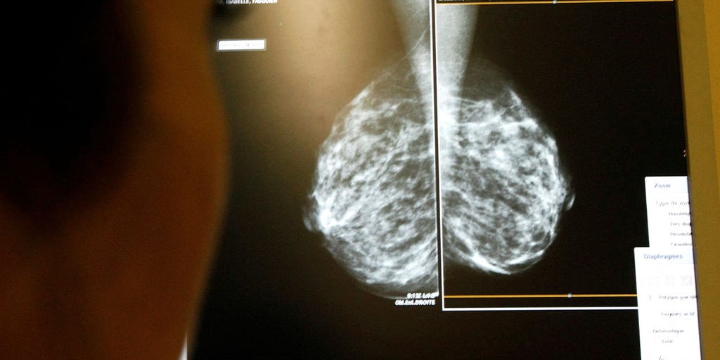 Artificial intelligence model to help scientists predict whether breast cancer will spread