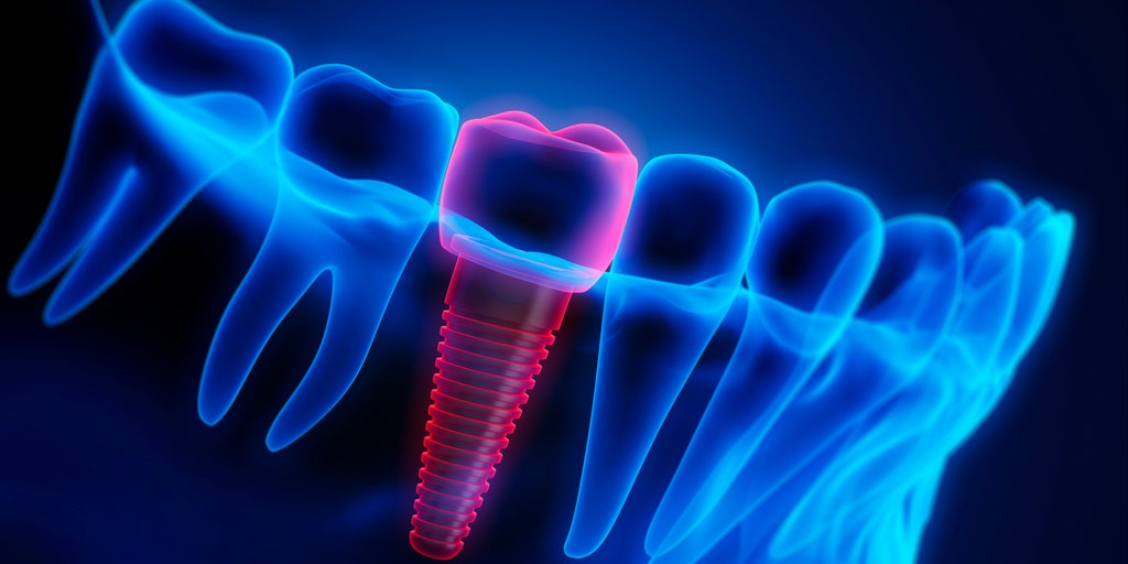 AI in dentistry: Researchers find that artificial intelligence can create better dental crowns