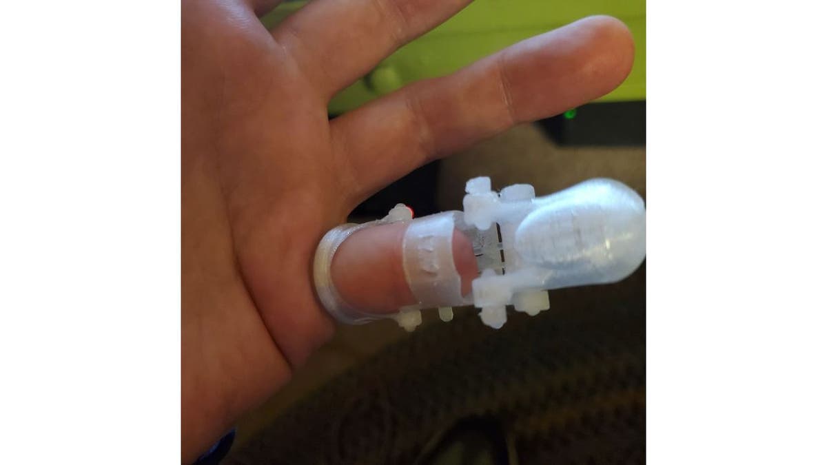 Man's hand with clear 3D-printed prosthetic pinky
