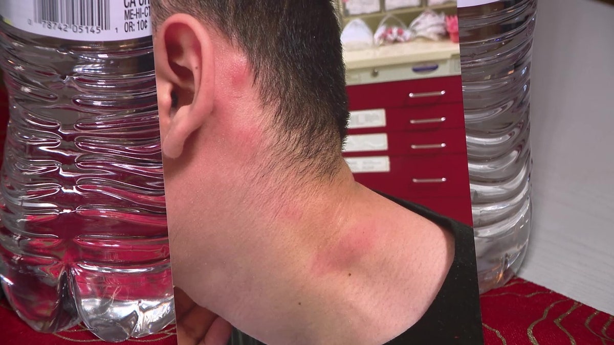 Welts on Vincent's neck