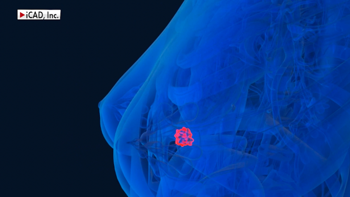 AI-powered program detects small breast cancer cells