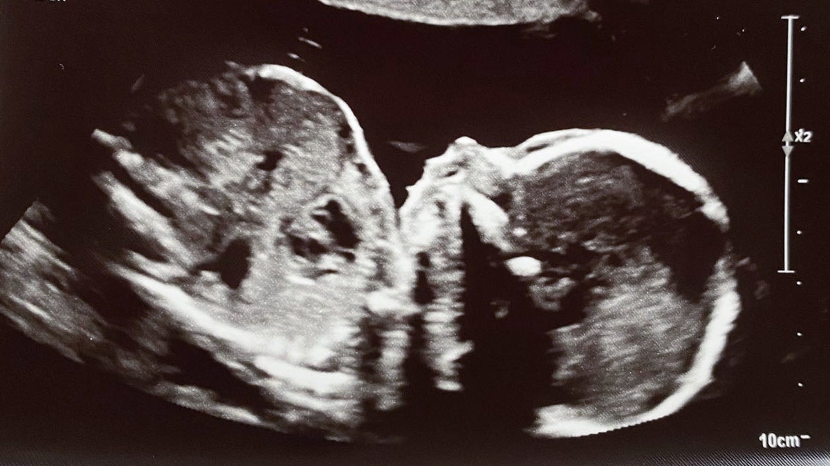 Ultrasound image of a baby at 19 weeks gestation