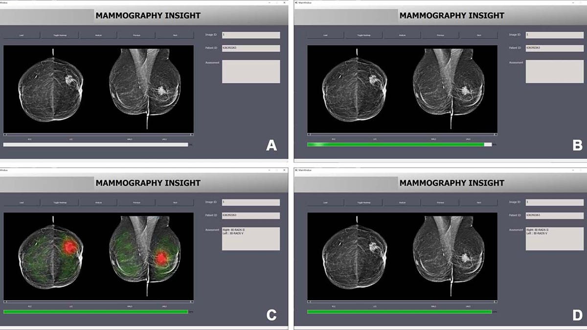 AI breast cancer