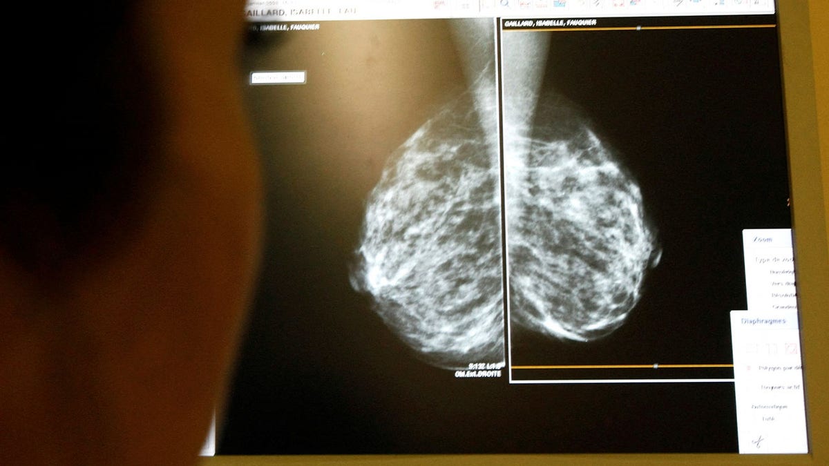 Breast cancer screening images