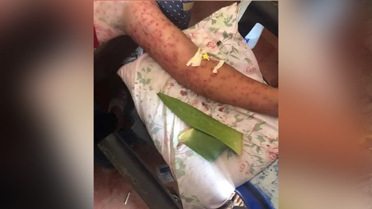 Arm with hundreds of bee stings