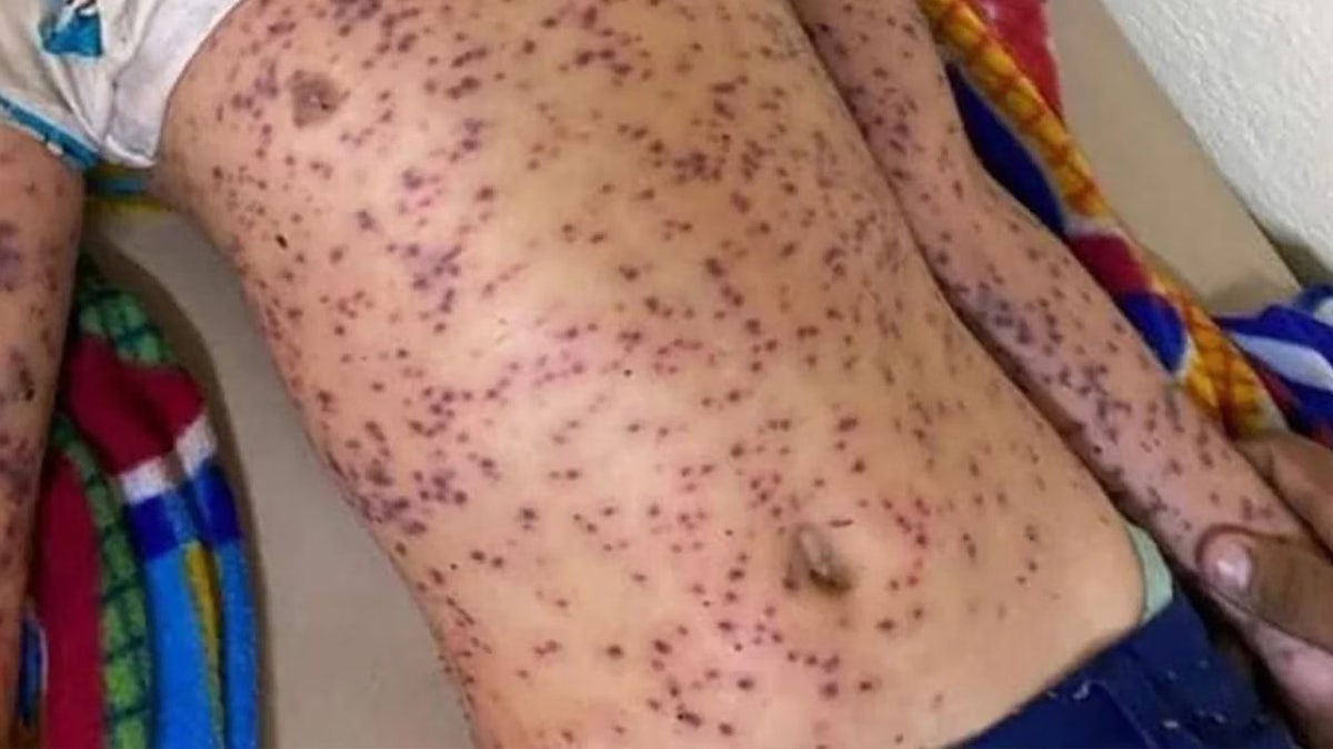 Bee stings on victim's torso