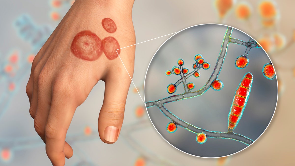 Tinea Corporis Infection Stock Photo - Download Image Now - Ringworm,  Allergy, Dermatitis - iStock