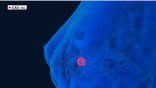 Doctors believe Artificial Intelligence is helping with early detection in cancer patients.