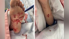 Pennsylvania teenager surfing in New Jersey suffers injuries from possible shark attack: reports