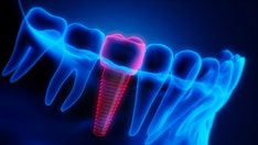 AI in dentistry: Researchers find that artificial intelligence can create better dental crowns