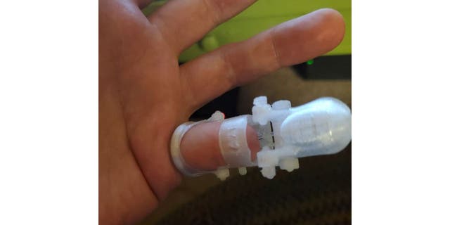 La mano de un hombre con un meñique protésico transparente impreso en 3D