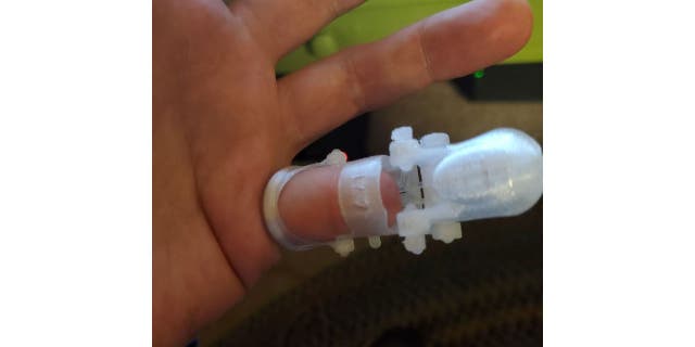 Man's hand with clear 3D-printed prosthetic pinky