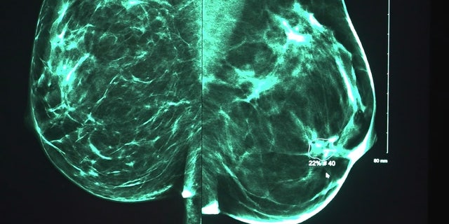 A scan showing a small cancerous tumor