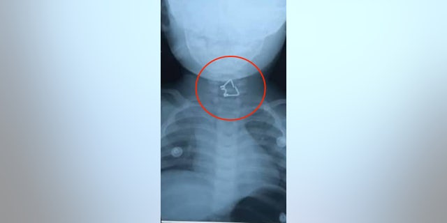 spring lodged in toddler x ray