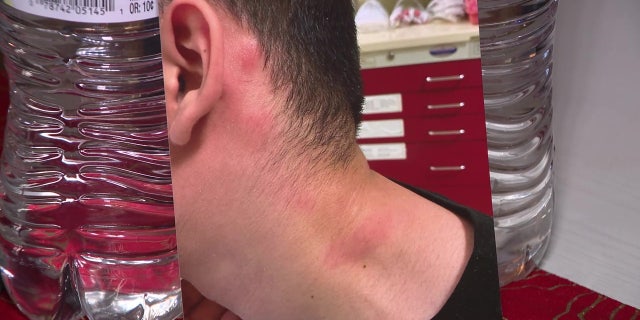 Welts on Vincent's neck