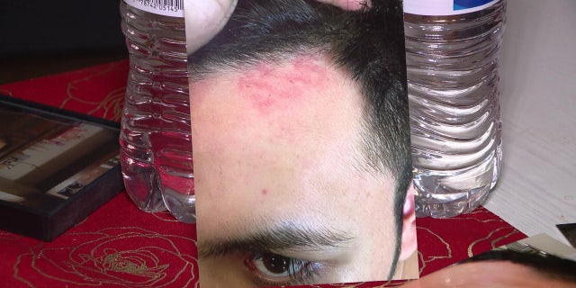 Vincent's head injury