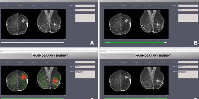 AI breast cancer