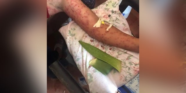 Arm with hundreds of bee stings