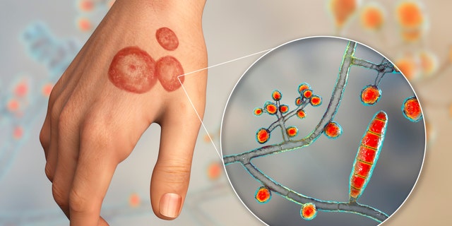 Ringworm proof against frequent antifungals for first time in US: What to know in regards to the pores and skin an infection