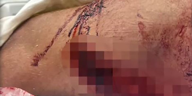 gashes in leg
