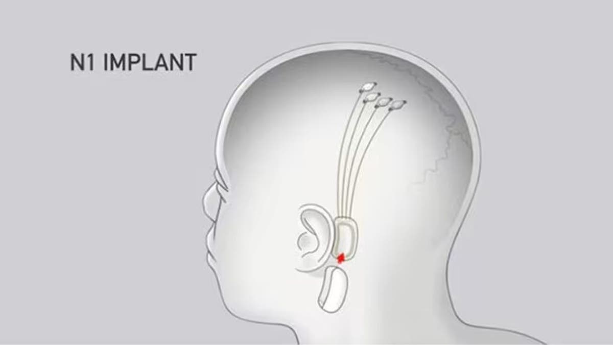 Implant ad with shape of man's head 