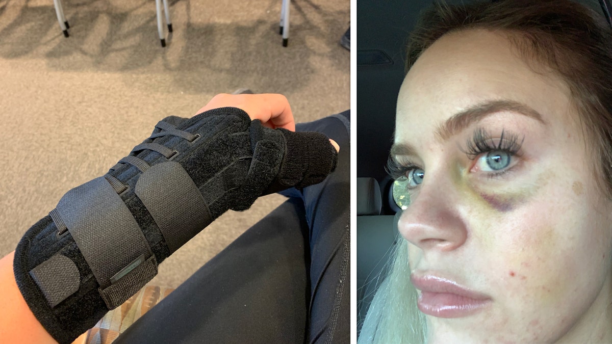 Deputy McCarthys injuries to her hand and face