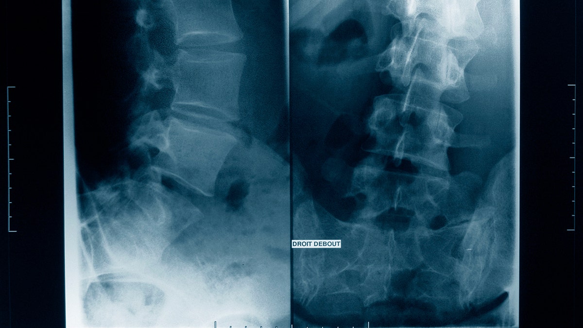 An x-ray showing scoliosis 