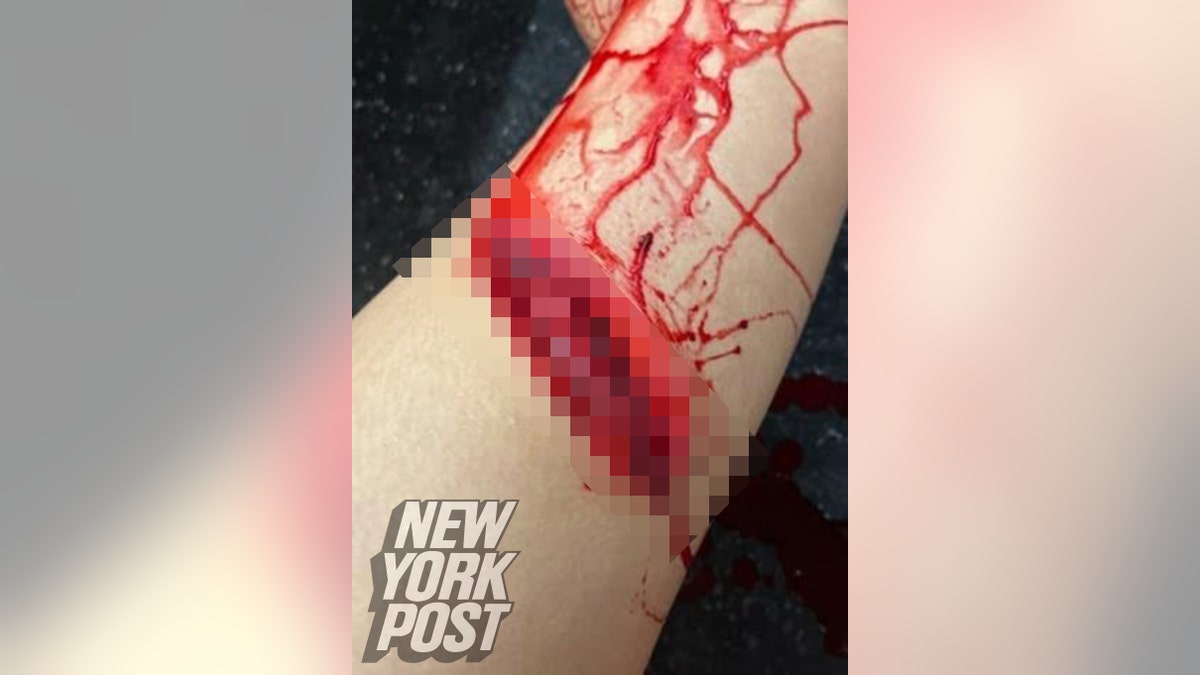 A deep, bleeding wound on a leg.