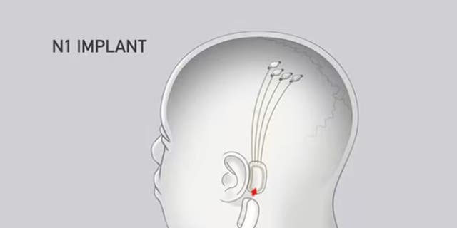 Implant ad with shape of man's head 