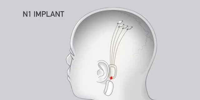 Implant ad with shape of man's head 