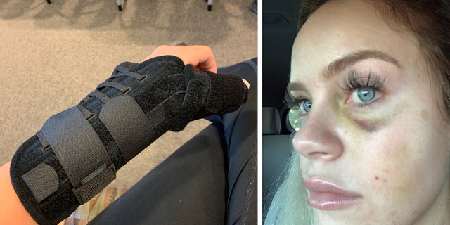 Deputy McCarthys injuries to her hand and face