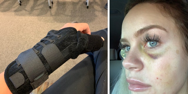 Deputy McCarthys injuries to her hand and face