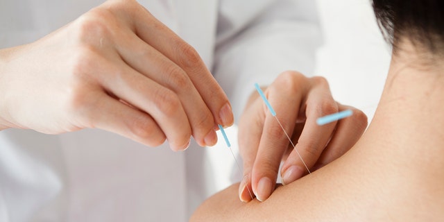 woman receives acupuncture