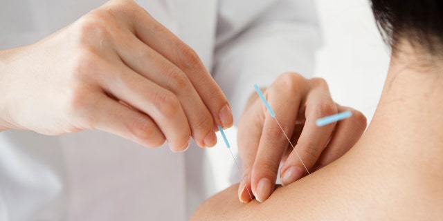 woman receives acupuncture