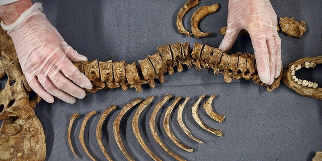 A spine affected by scoliosis