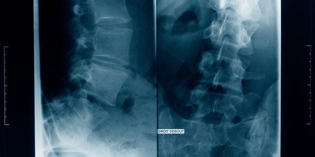 Una radiografía que muestra escoliosis 