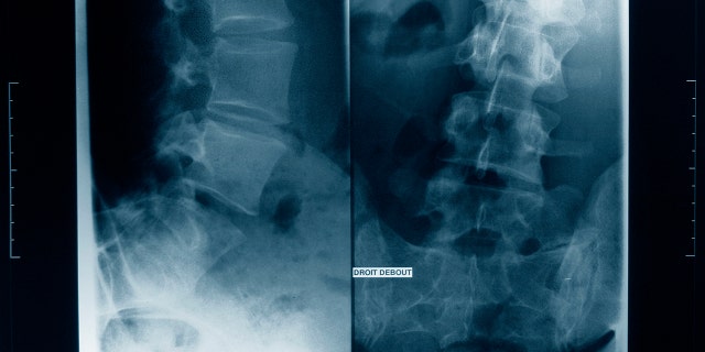 An x-ray showing scoliosis 