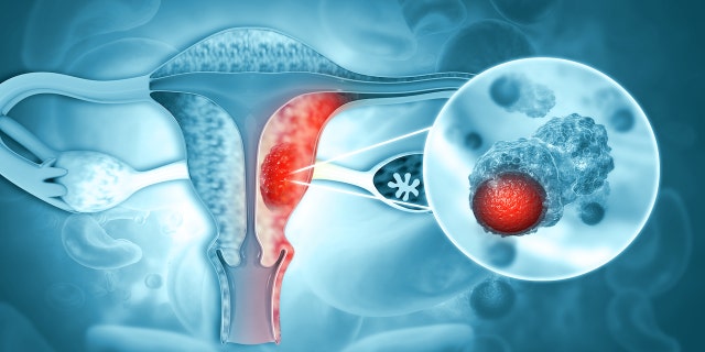 Uterine cancer