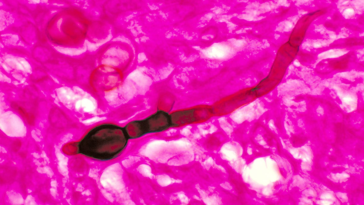 Blastomyces Dermatitidis