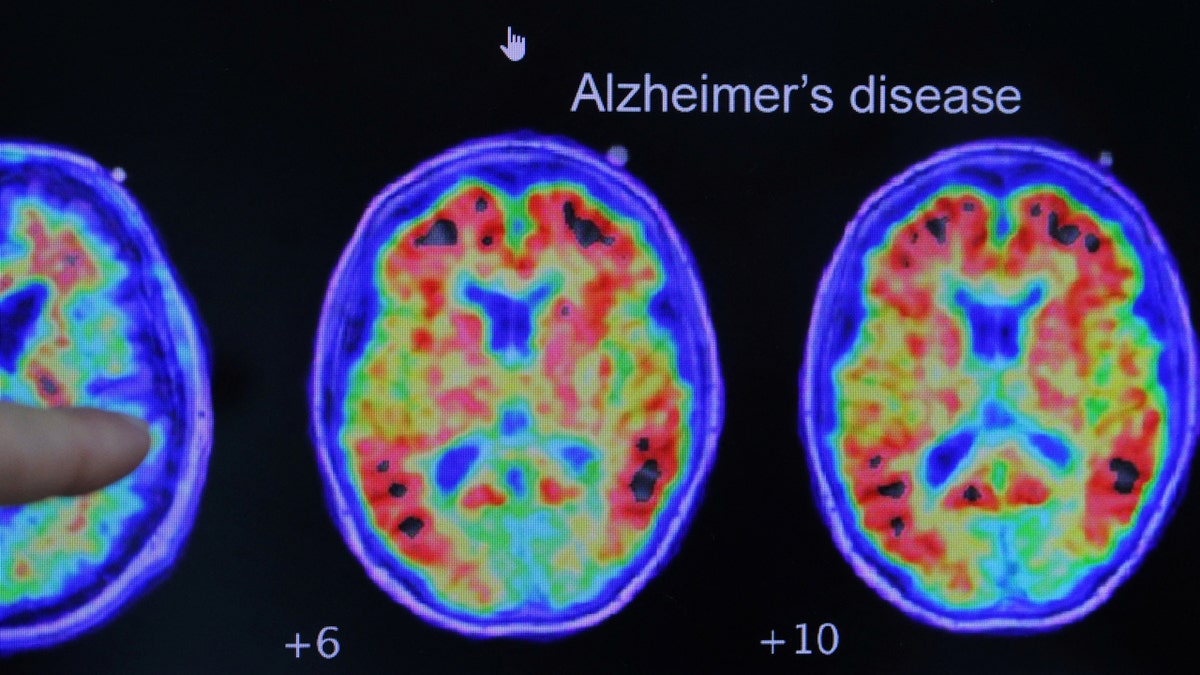 Evidence of Alzheimer’s disease