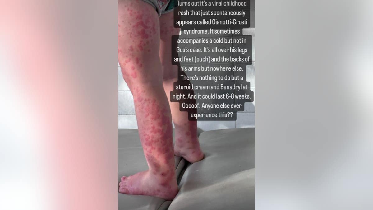 Mandy Moore showing photo of Gus’s legs covered in red patches